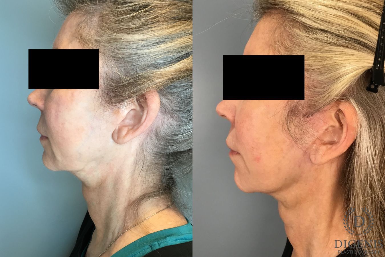 Before and after Temple Lift case 46416 - Angle 5