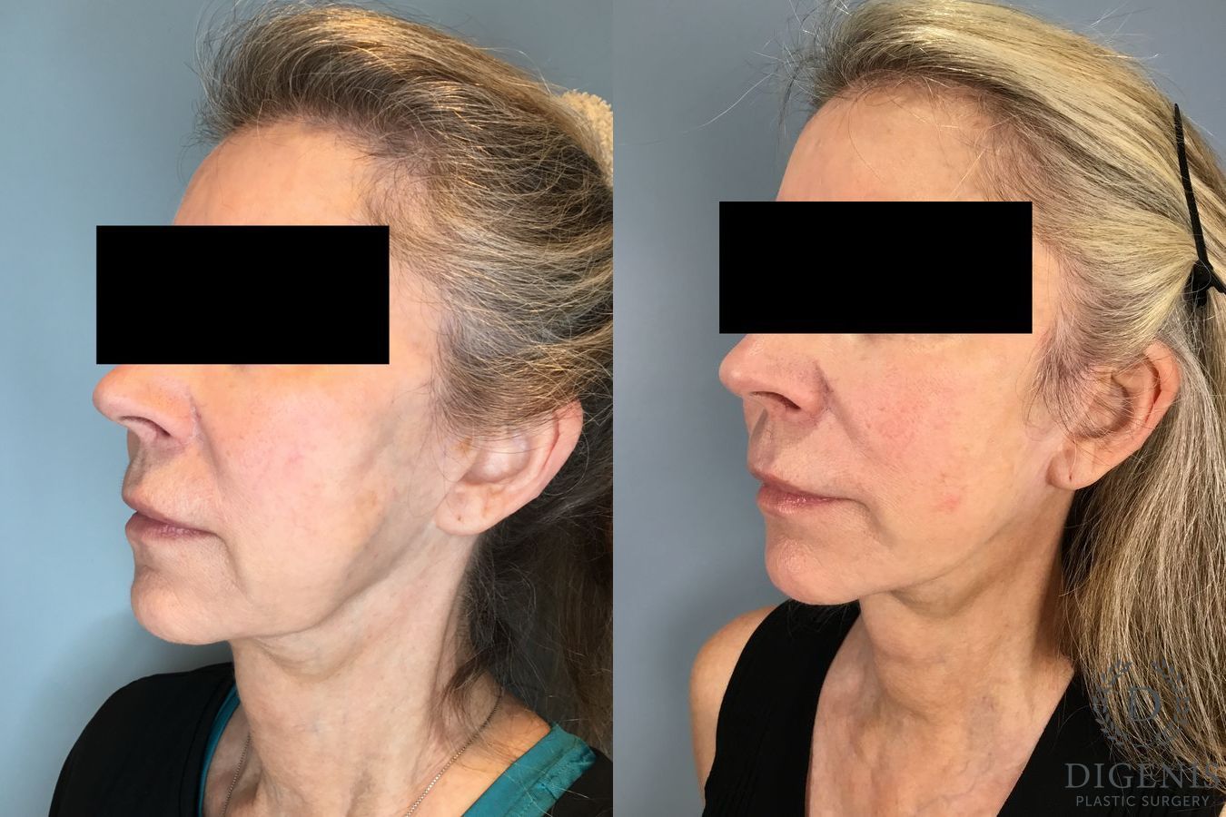 Before and after Temple Lift case 46416 - Angle 4