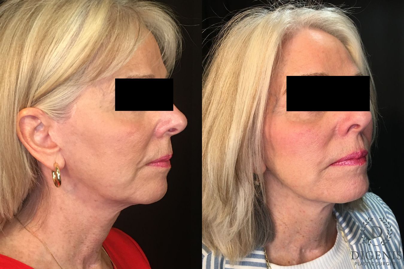 Before and after Temple Lift case 35194 - Angle 2