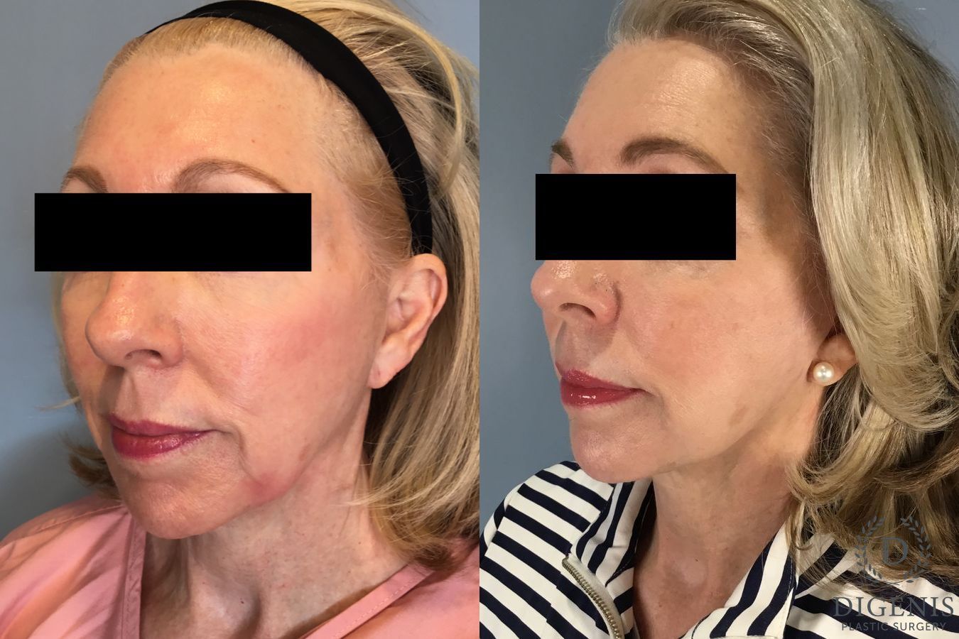 Before and after Temple Lift case 41711 - Angle 2