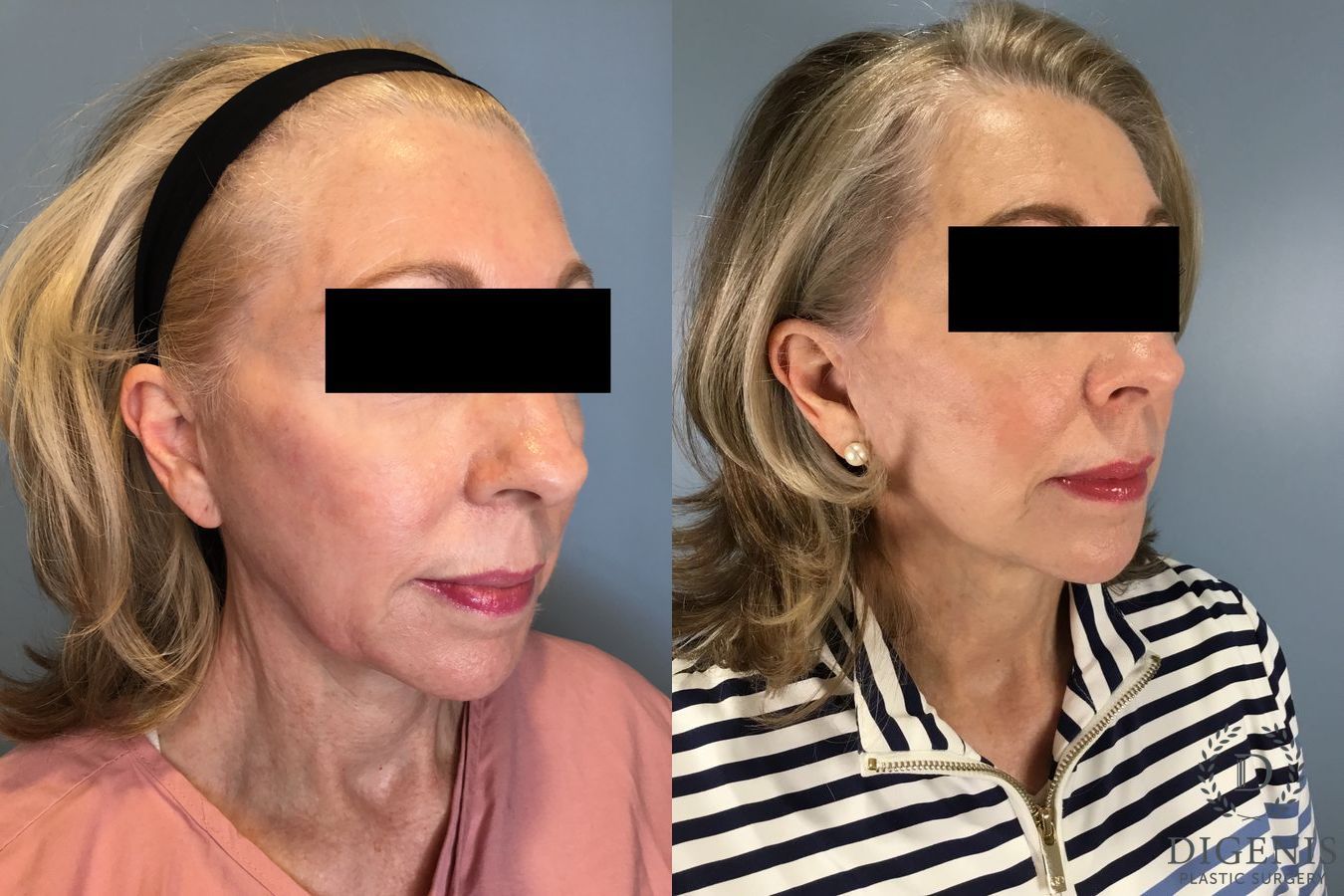 Before and after Temple Lift case 41711 - Angle 4