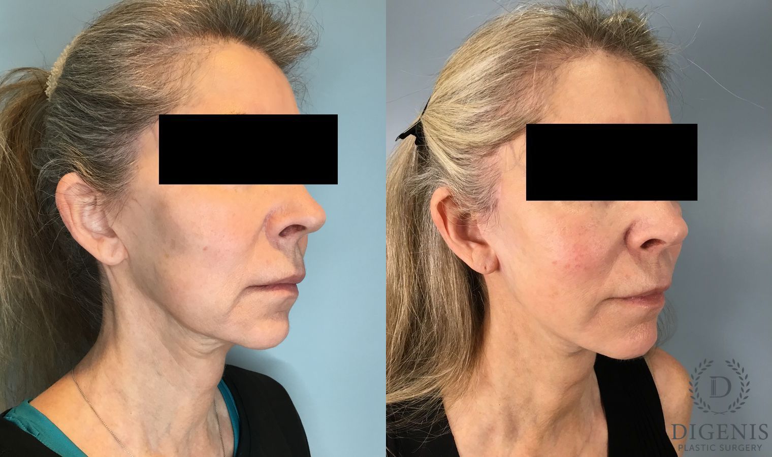 Before and after Temple Lift case 46416 - Angle 2