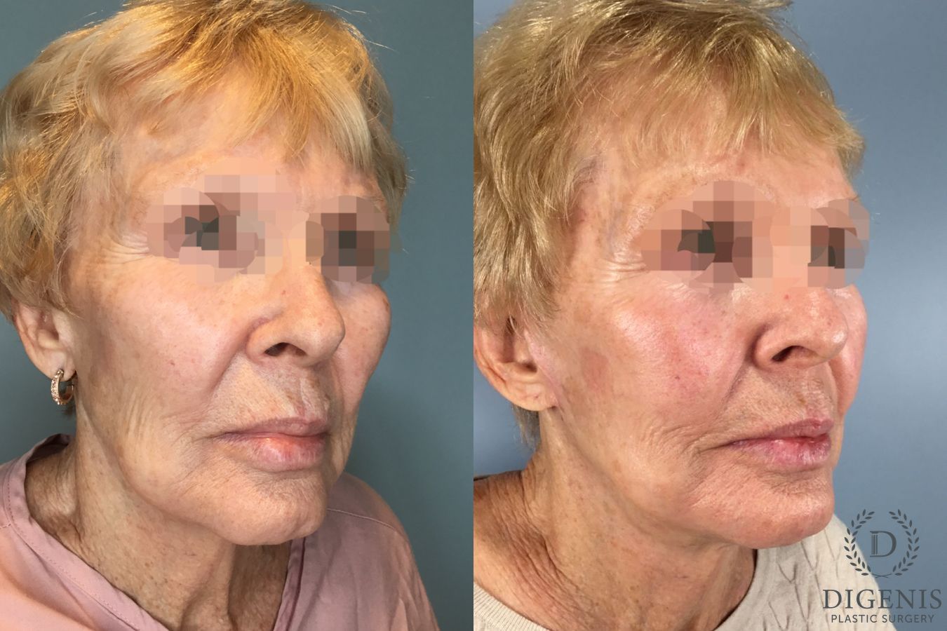 Before and after Temple Lift case 43450 - Angle 4