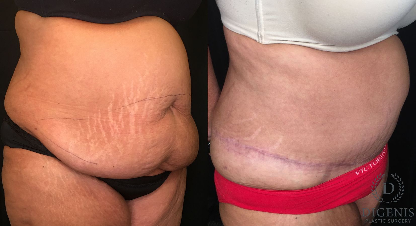Before and after Tummy Tuck case 35173 - Angle 2
