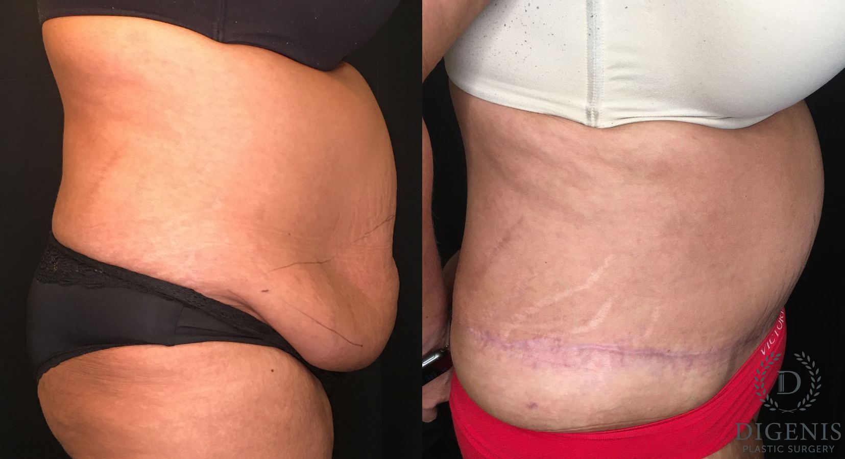 Before and after Tummy Tuck case 35173 - Angle 3