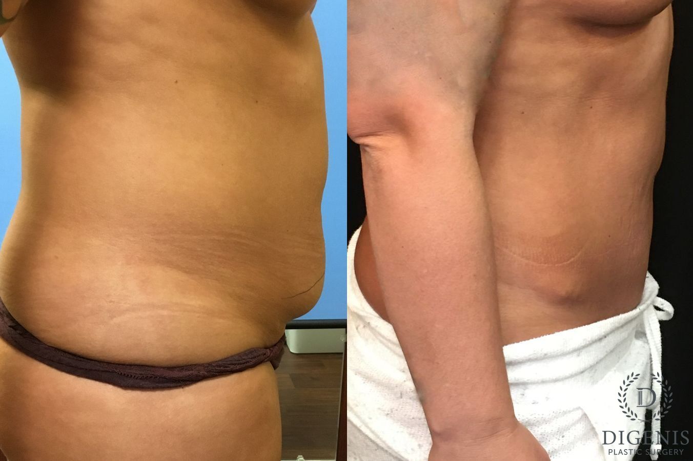 Before and after Tummy Tuck case 35066 - Angle 3