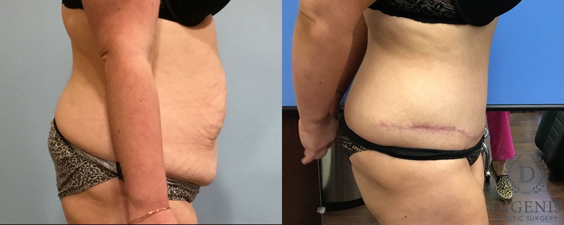 Before and after Tummy Tuck case 35090 - Angle 3