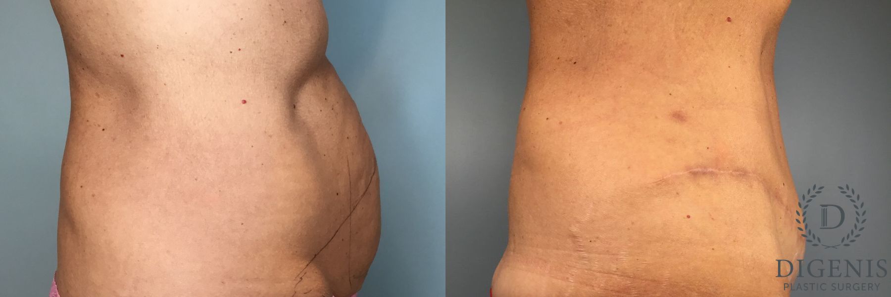 Before and after Tummy Tuck case 49484 - Angle 5
