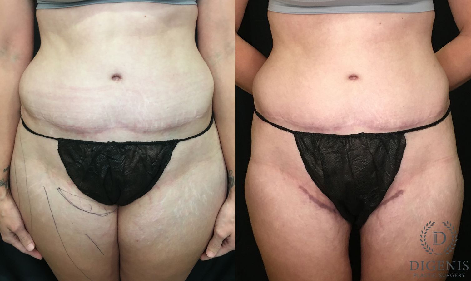 Before and after Tummy Tuck case 35180