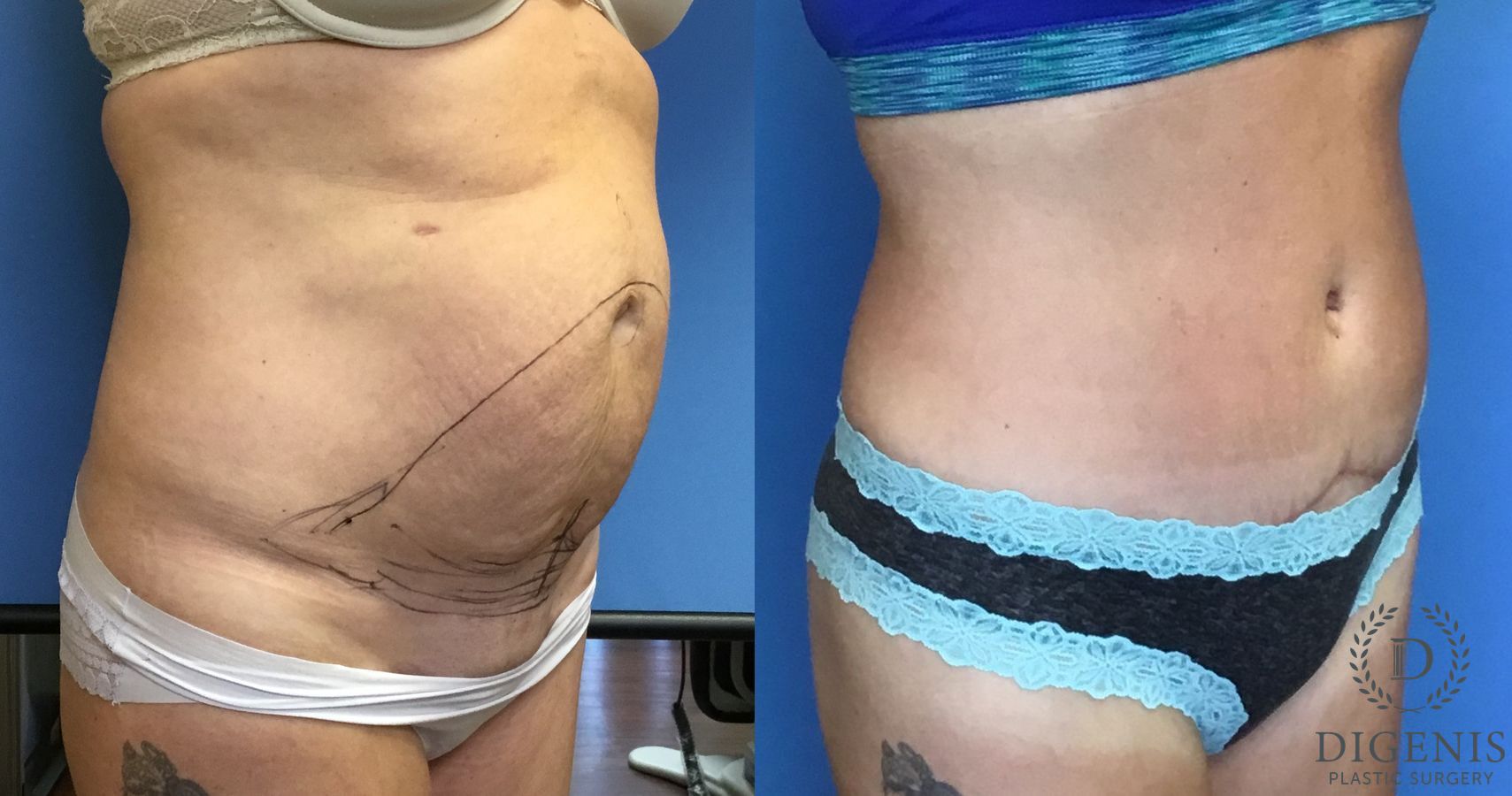 Before and after Tummy Tuck case 35060 - Angle 2
