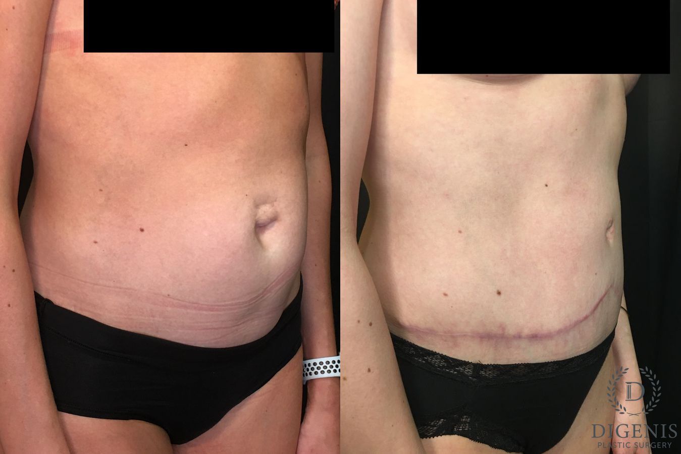 Before and after Tummy Tuck case 35052 - Angle 2