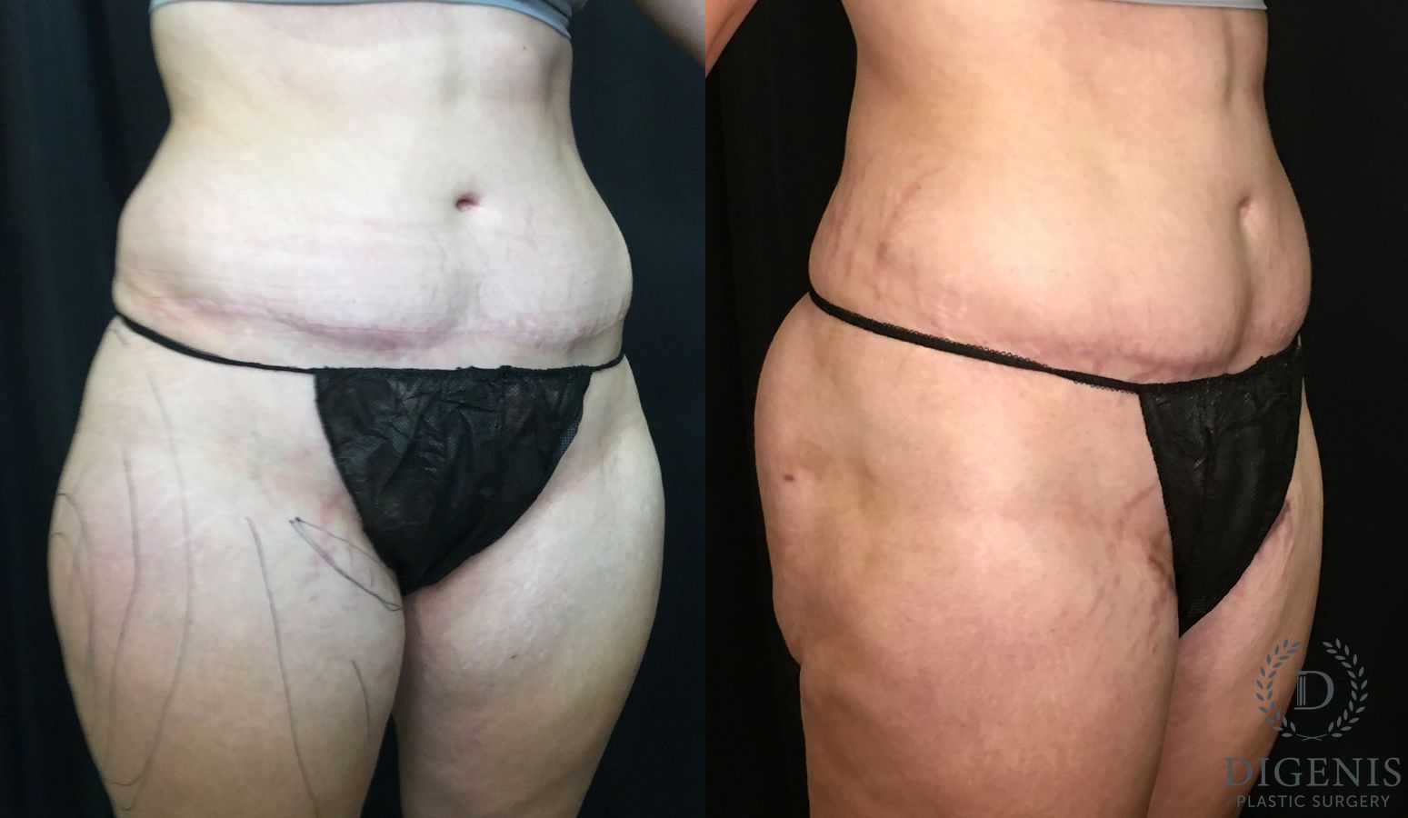 Before and after Tummy Tuck case 35180 - Angle 2