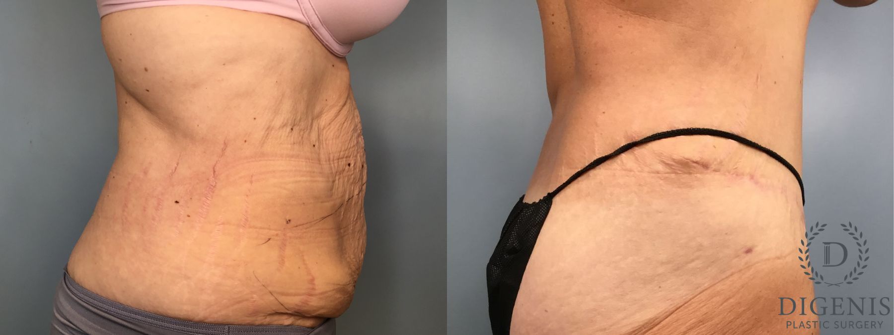 Before and after Tummy Tuck case 43252 - Angle 3