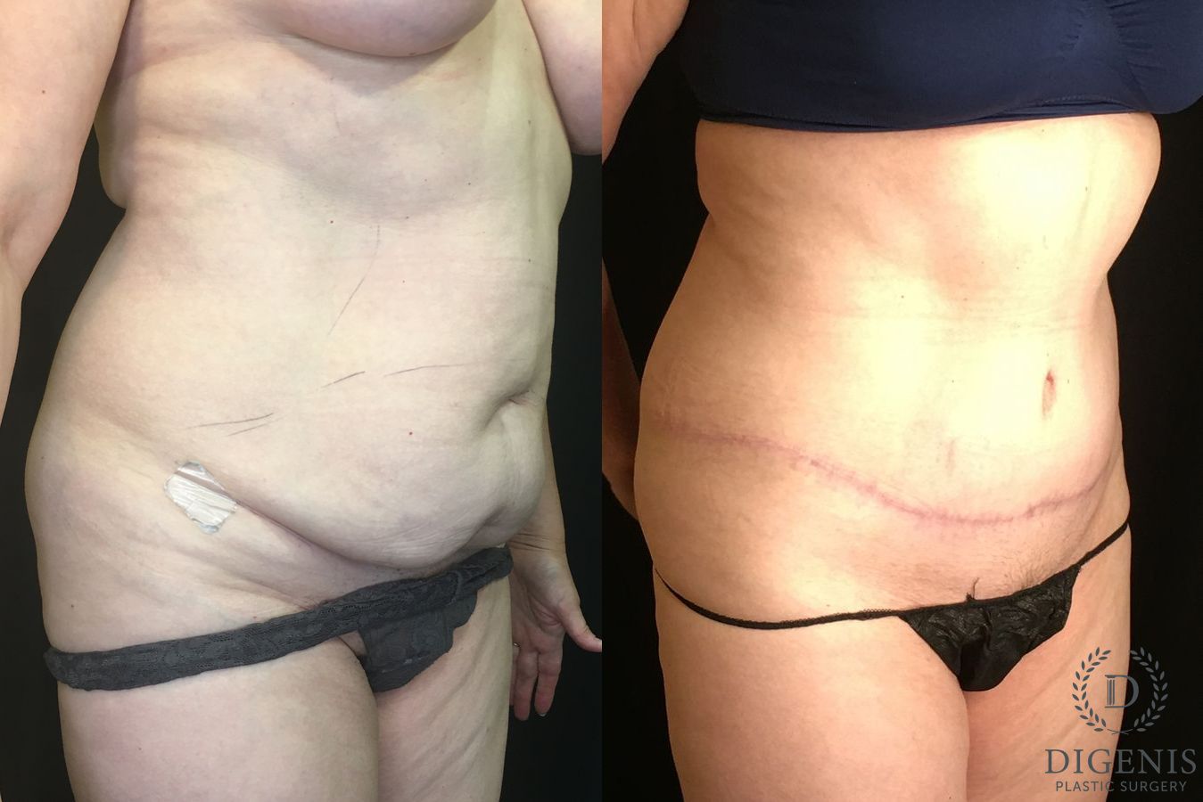 Before and after Tummy Tuck case 35191 - Angle 2