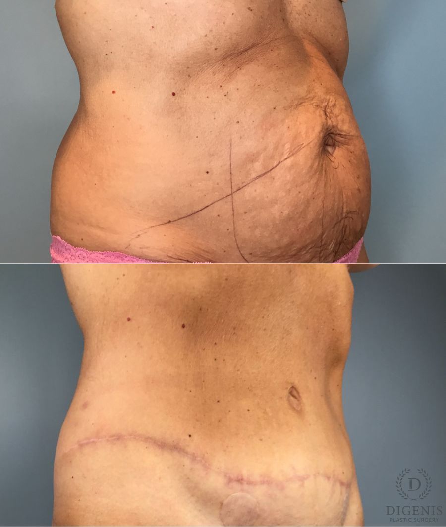 Before and after Tummy Tuck case 49484 - Angle 4
