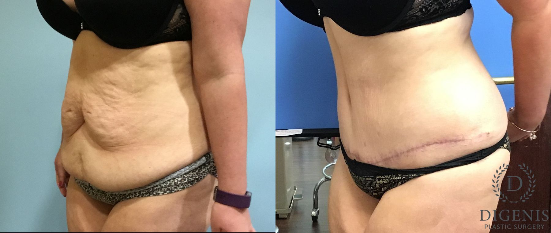 Before and after Tummy Tuck case 35090 - Angle 4