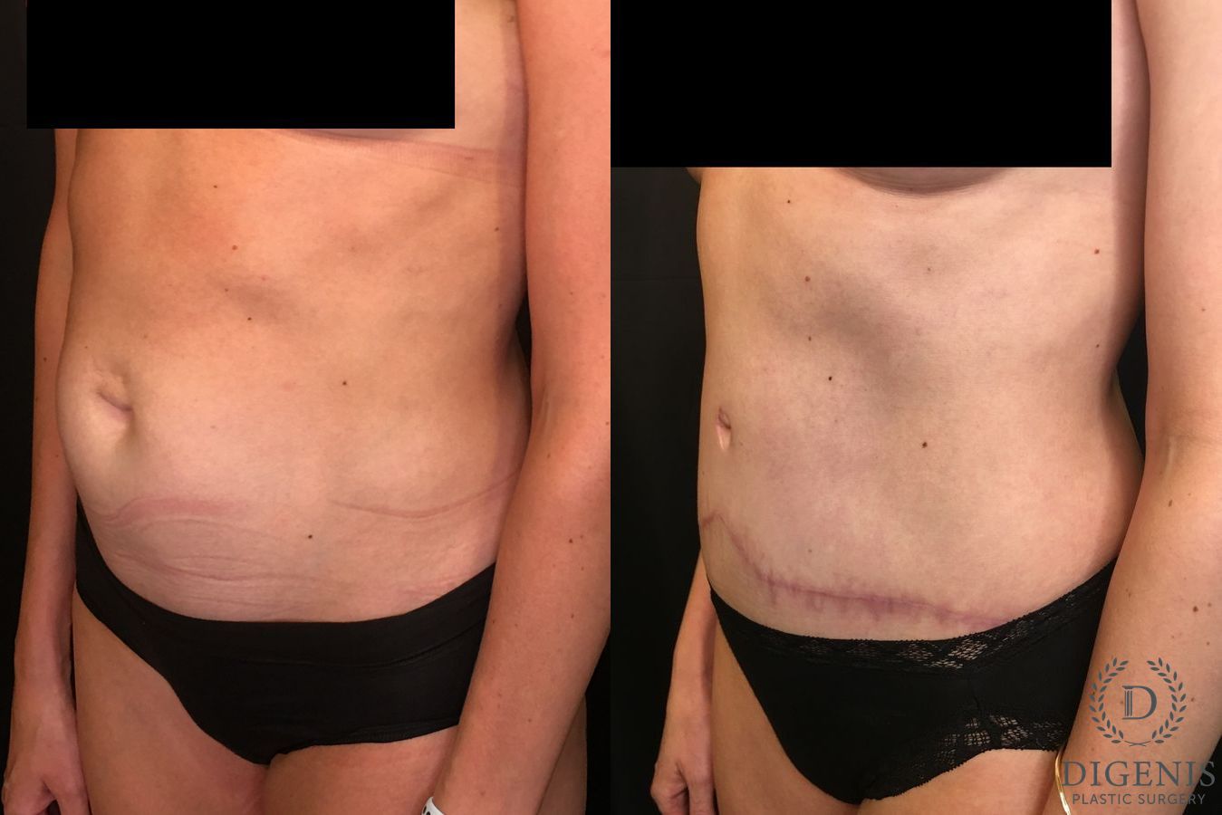 Before and after Tummy Tuck case 35052 - Angle 4