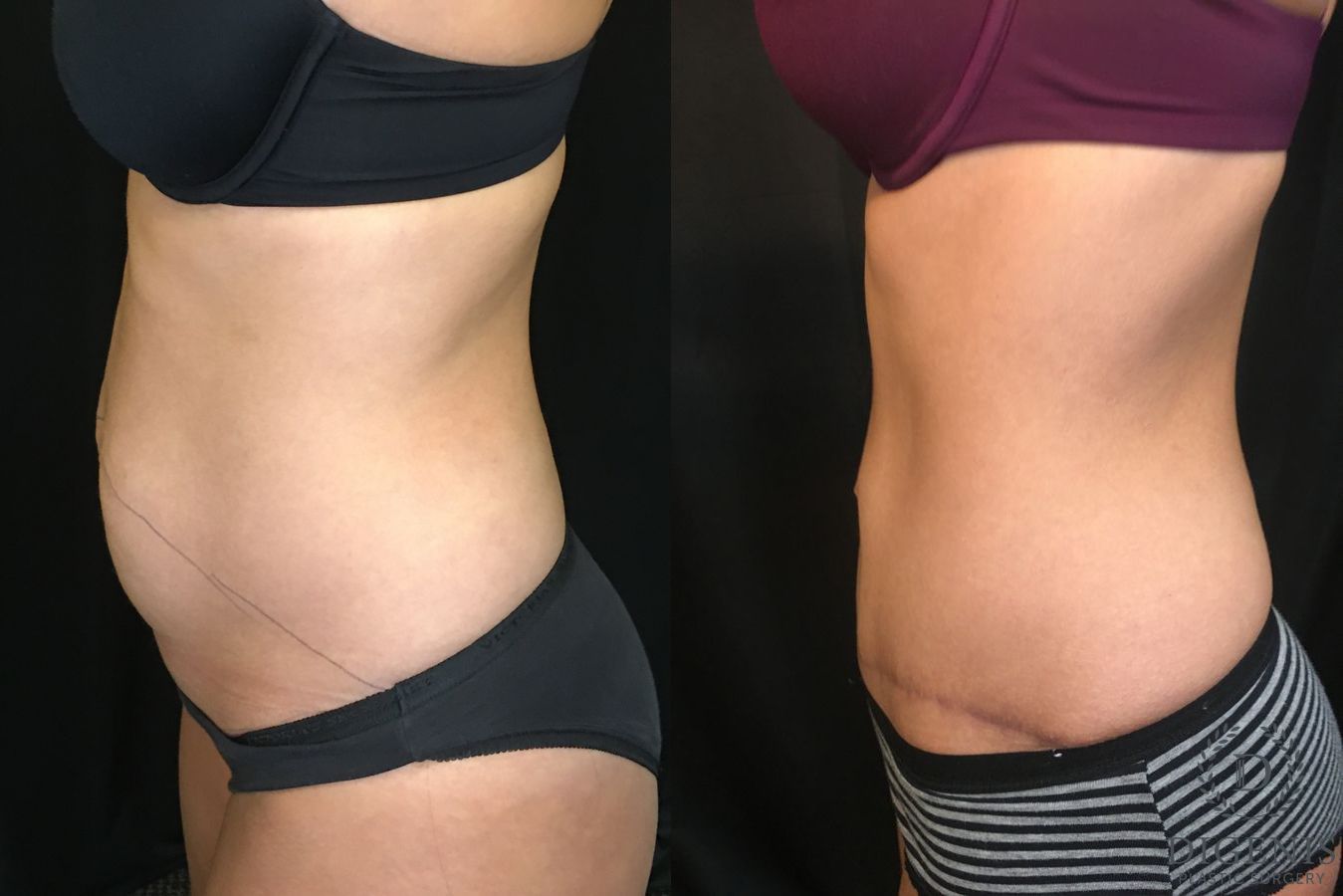 Before and after Tummy Tuck case 35152 - Angle 5