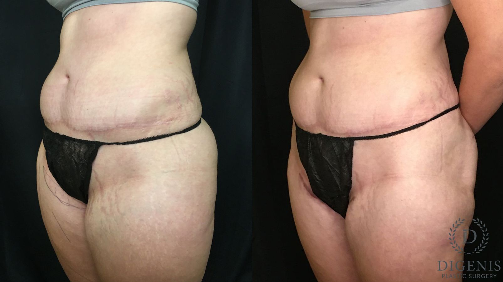 Before and after Tummy Tuck case 35180 - Angle 4