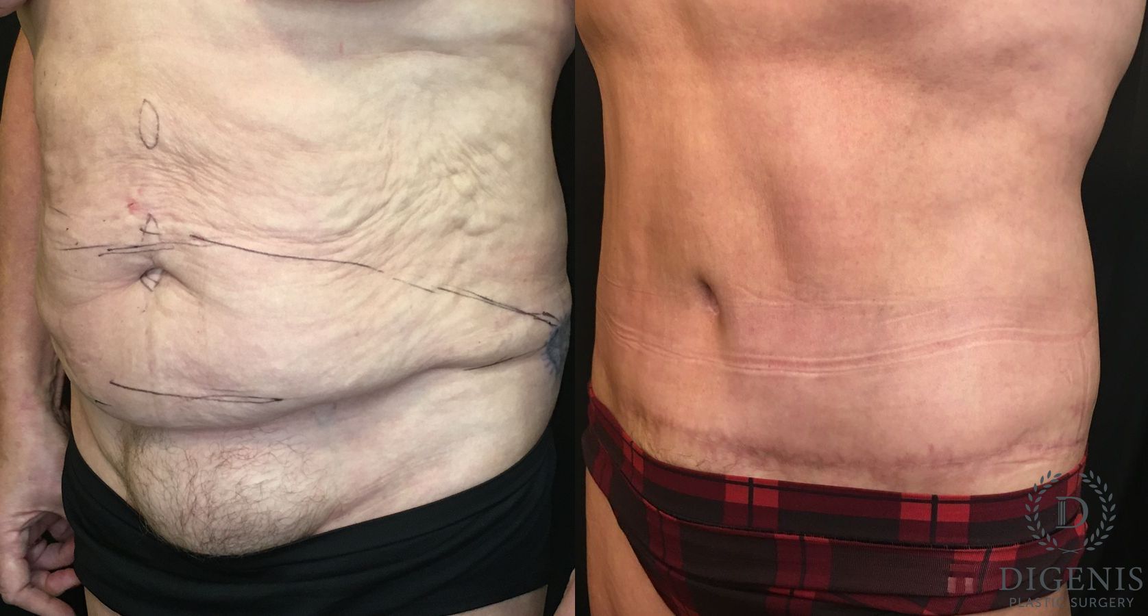 Before and after Tummy Tuck case 35148 - Angle 4