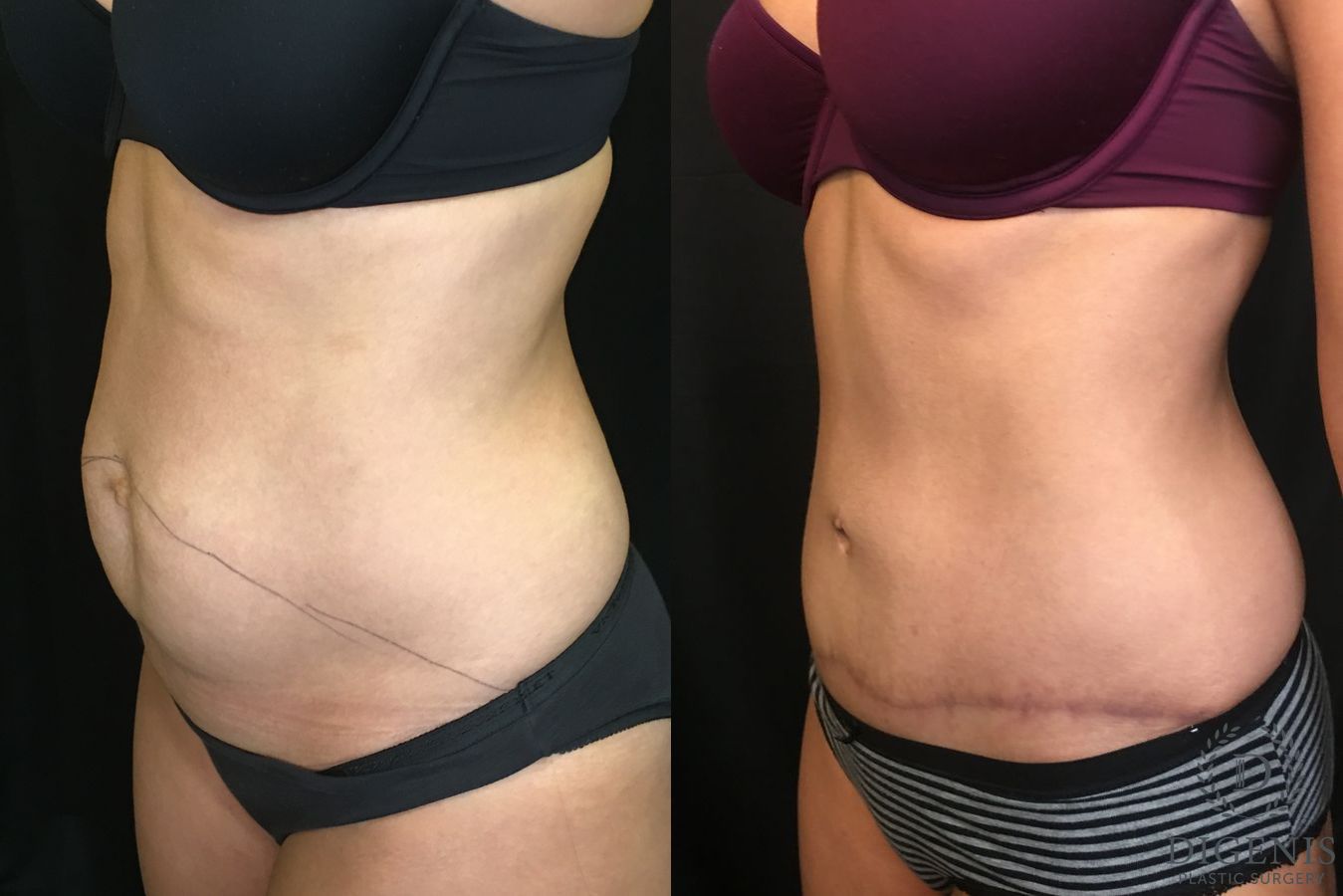 Before and after Tummy Tuck case 35152 - Angle 4