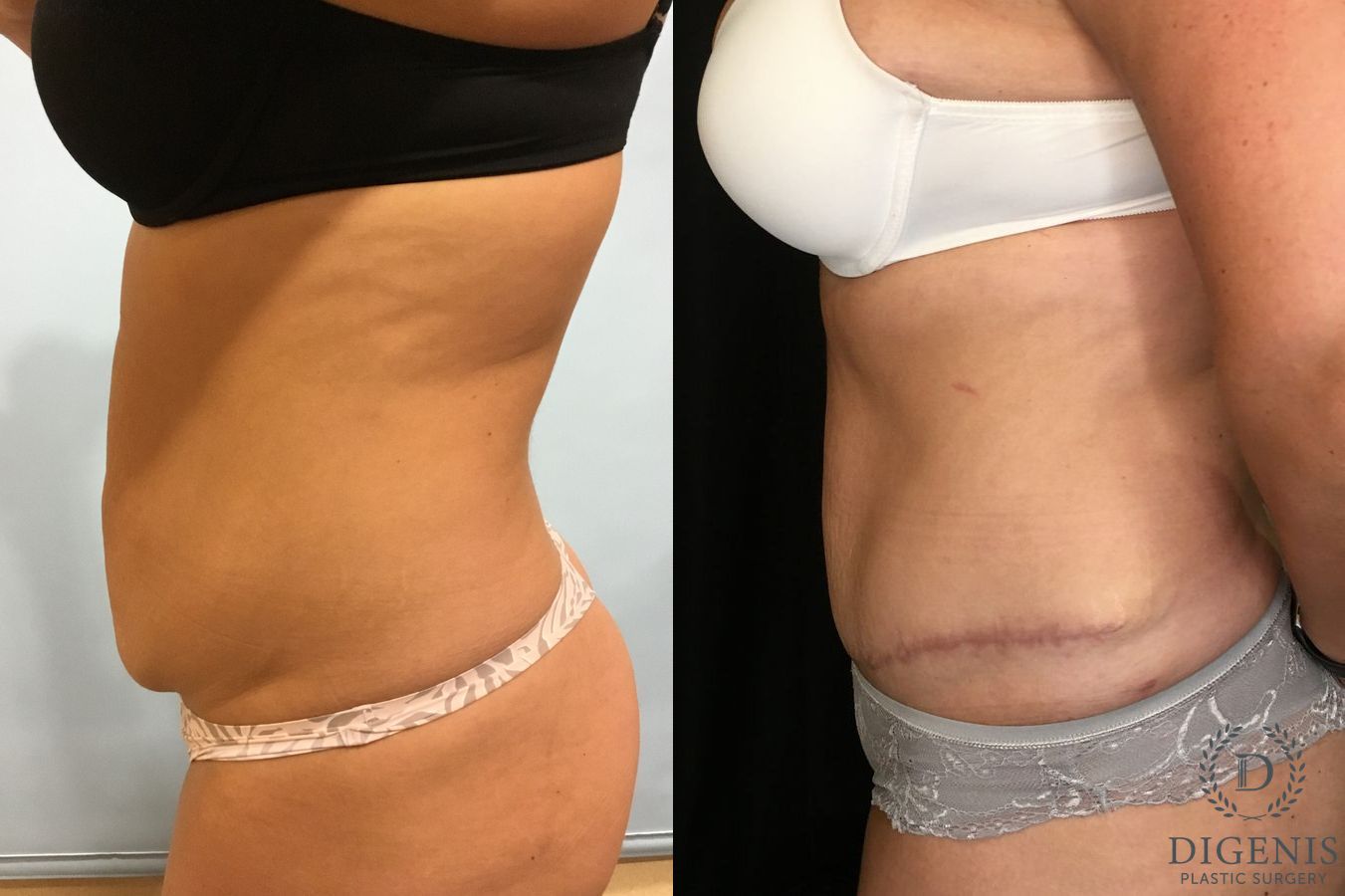 Before and after Tummy Tuck case 35128 - Angle 3