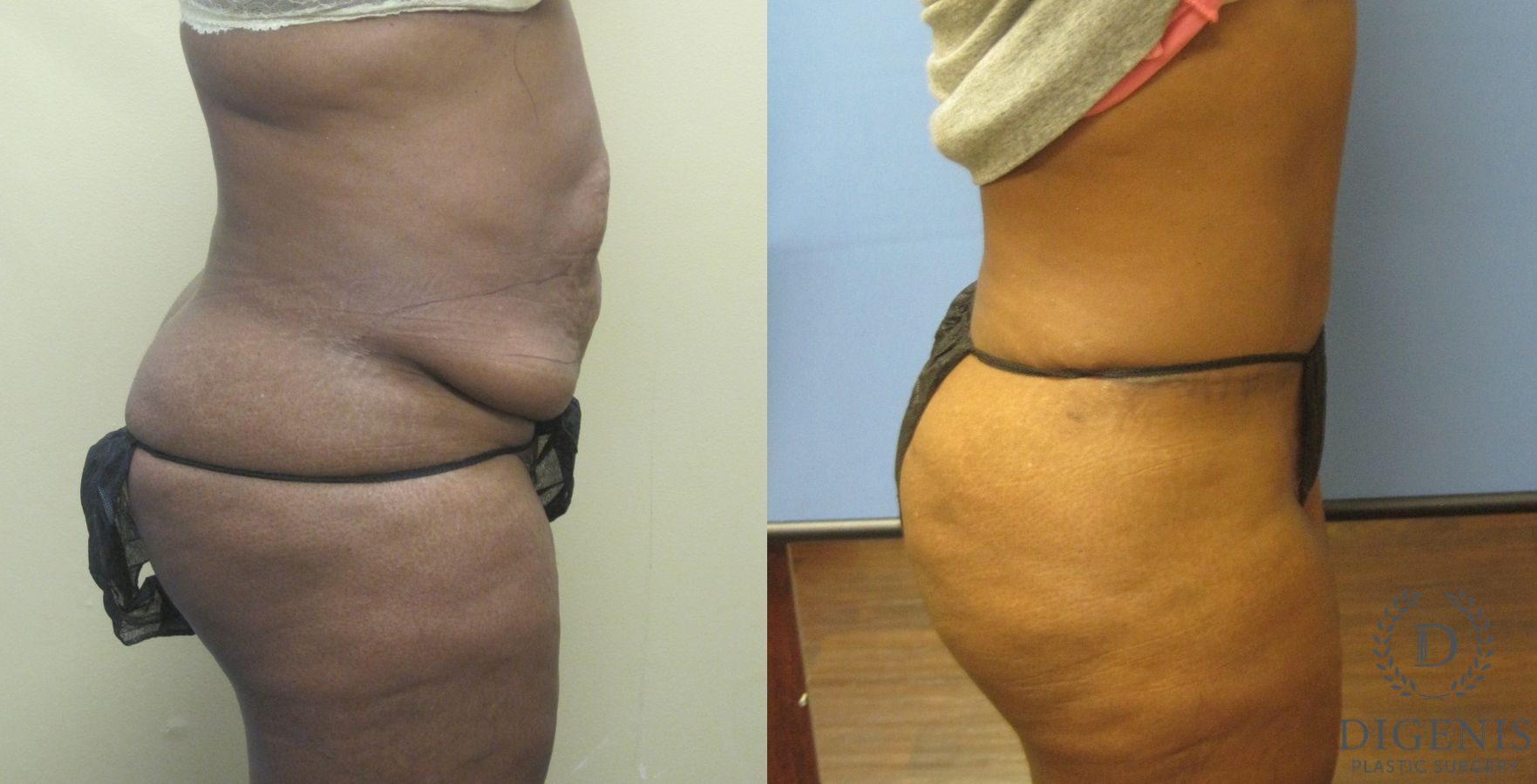 Before and after Tummy Tuck case 35082 - Angle 3