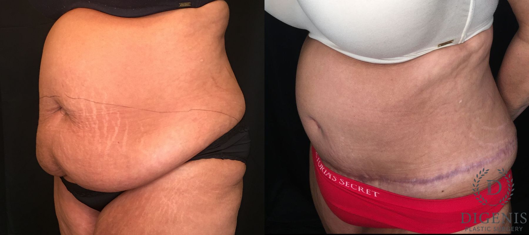 Before and after Tummy Tuck case 35173 - Angle 4