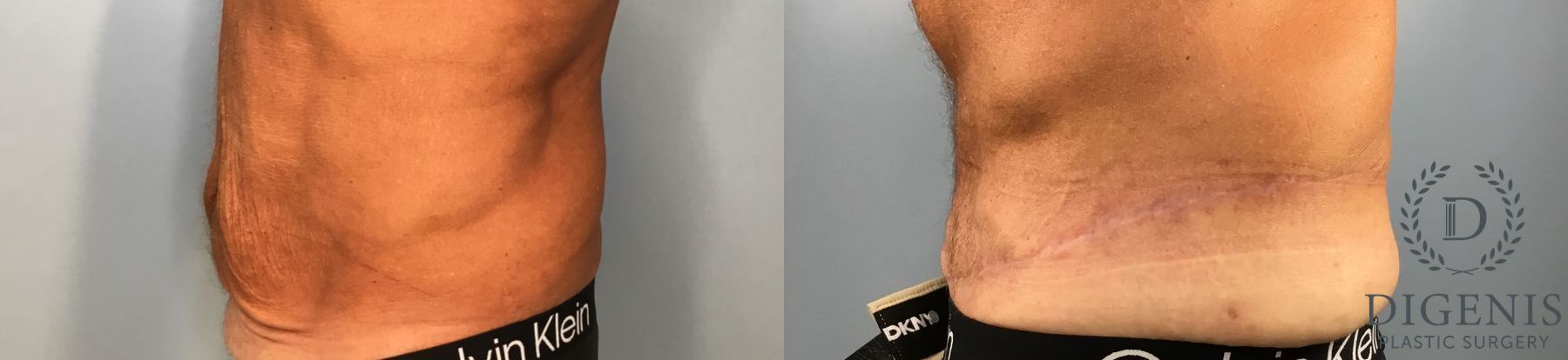 Before and after Tummy Tuck case 43448 - Angle 3