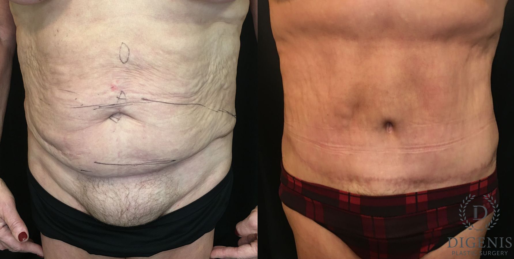 Before and after Tummy Tuck case 35148