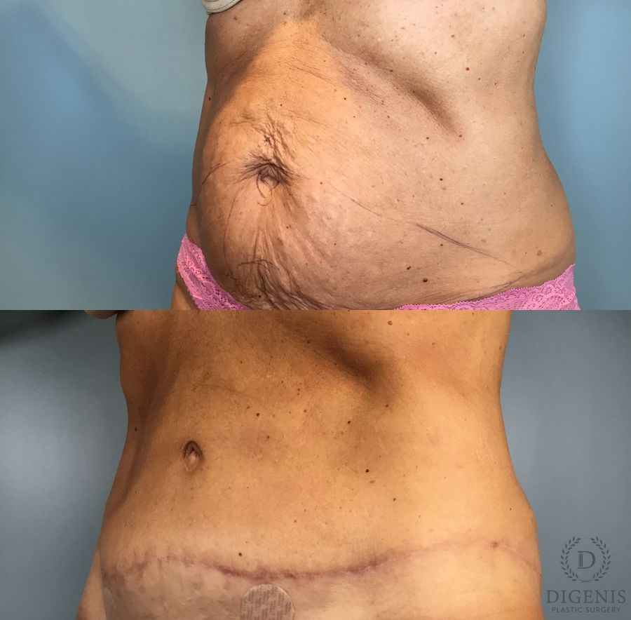Before and after Tummy Tuck case 49484 - Angle 2