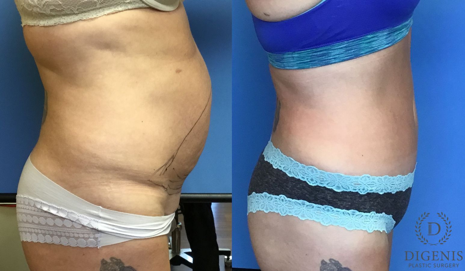 Before and after Tummy Tuck case 35060 - Angle 3