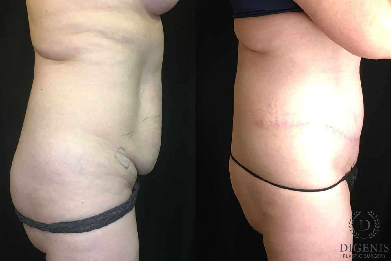 Before and after Tummy Tuck case 35191 - Angle 3
