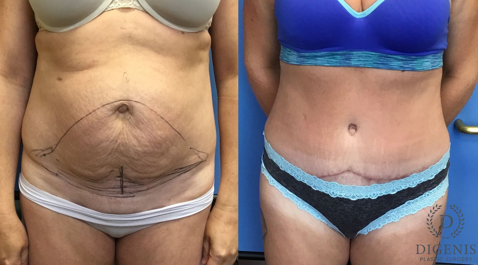 Before and after Tummy Tuck case 35060