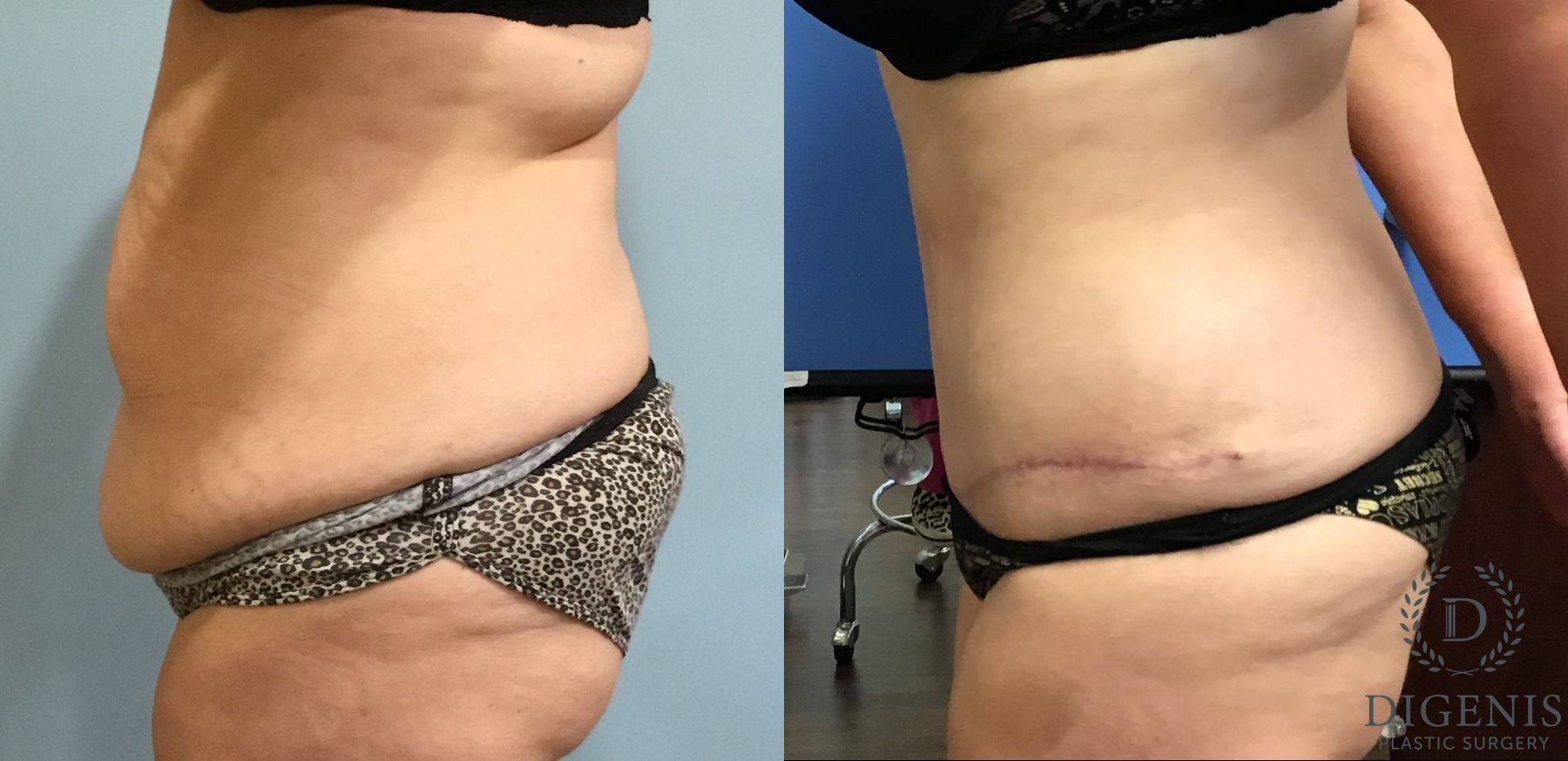 Before and after Tummy Tuck case 35090 - Angle 5