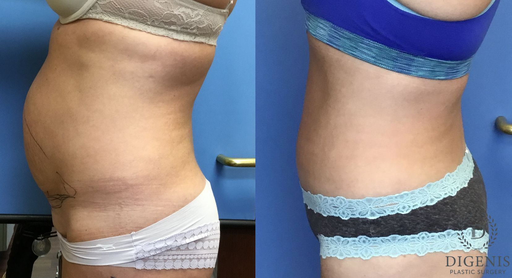 Before and after Tummy Tuck case 35060 - Angle 4