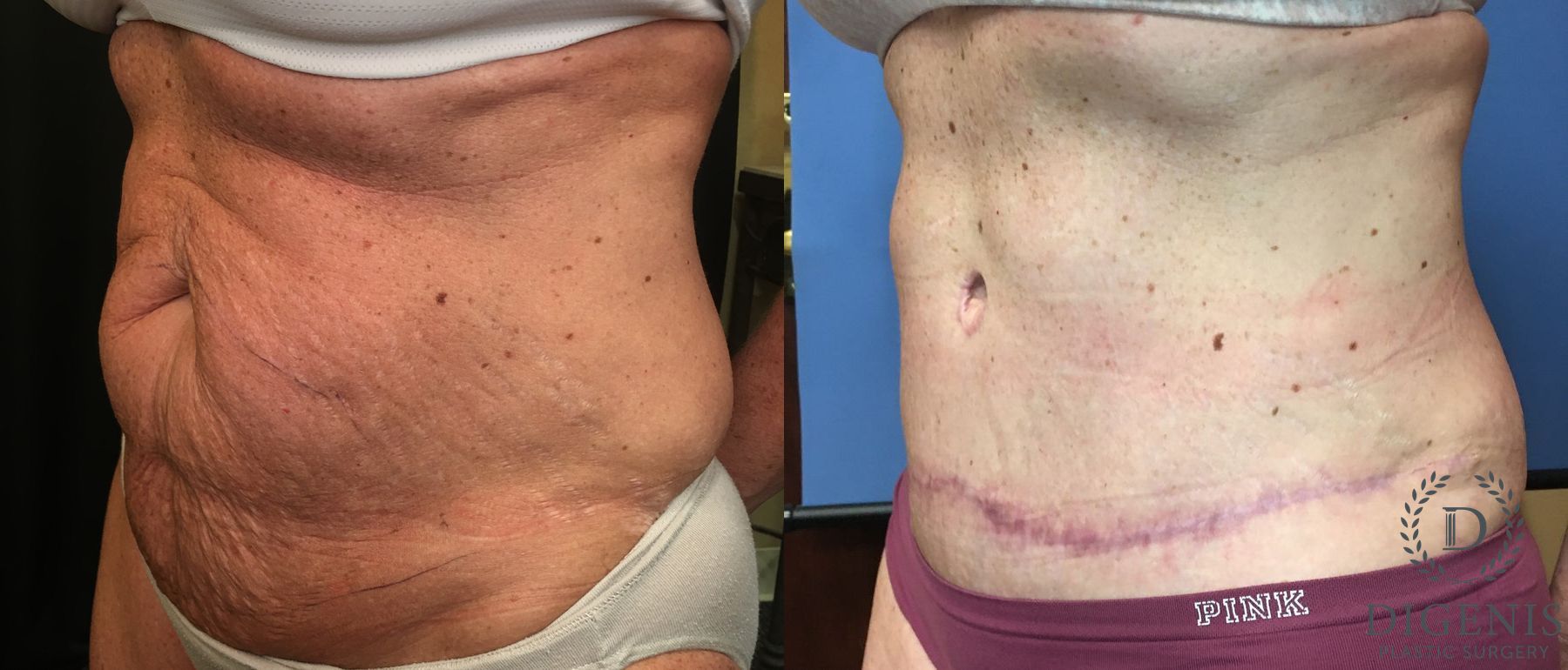 Before and after Tummy Tuck case 35149 - Angle 4