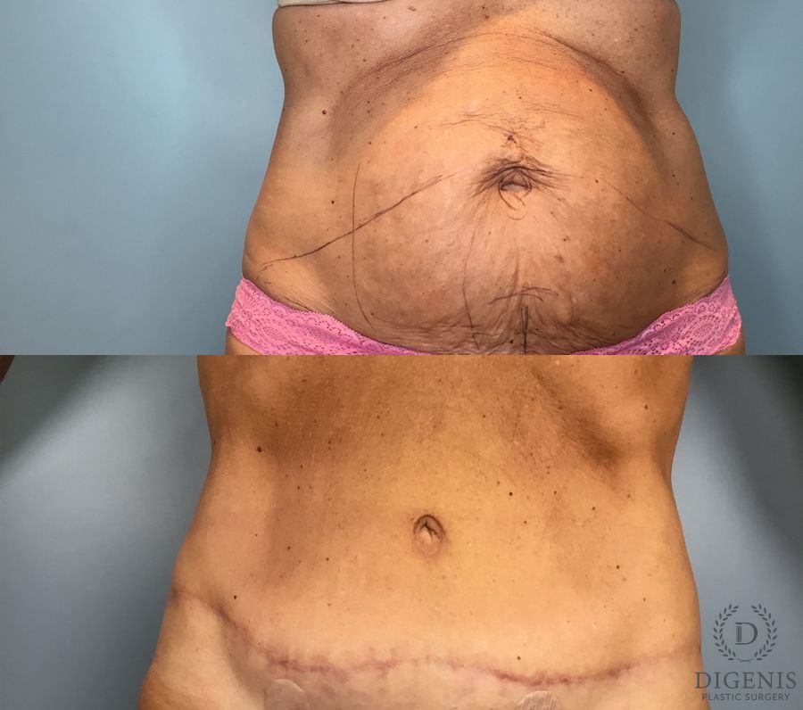 Before and after Tummy Tuck case 49484
