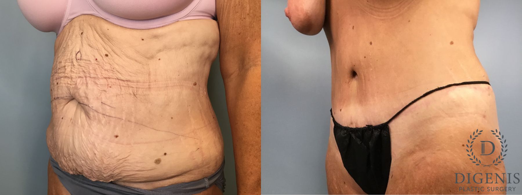 Before and after Tummy Tuck case 43252 - Angle 4