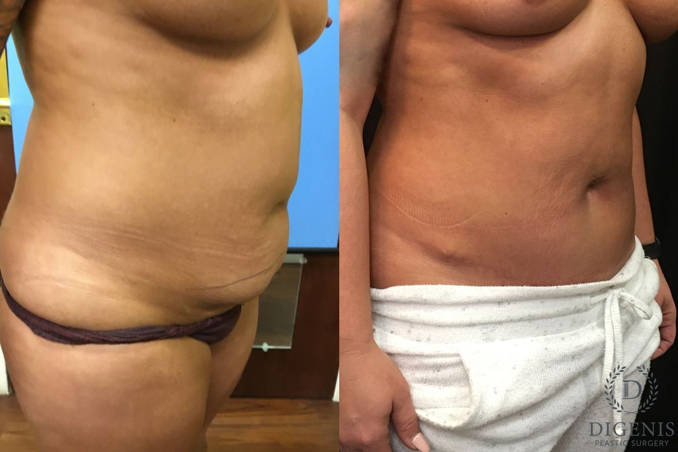 Before and after Tummy Tuck case 35066 - Angle 2