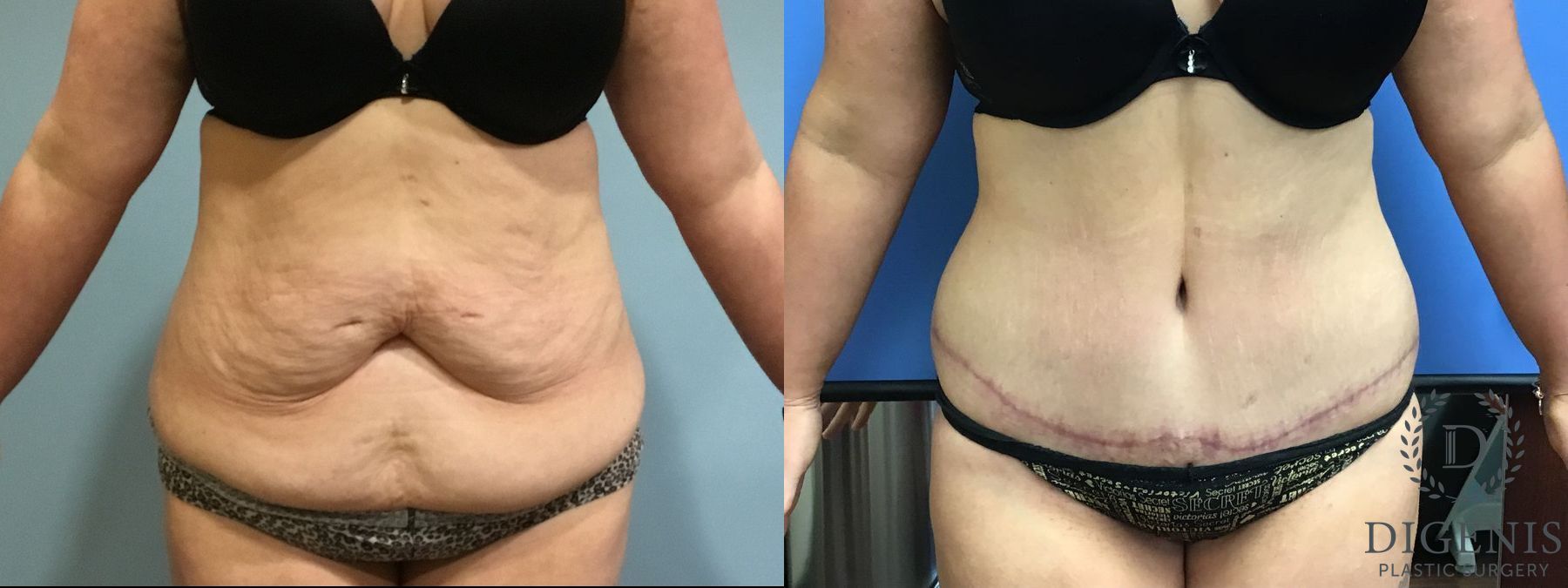 Before and after Tummy Tuck case 35090