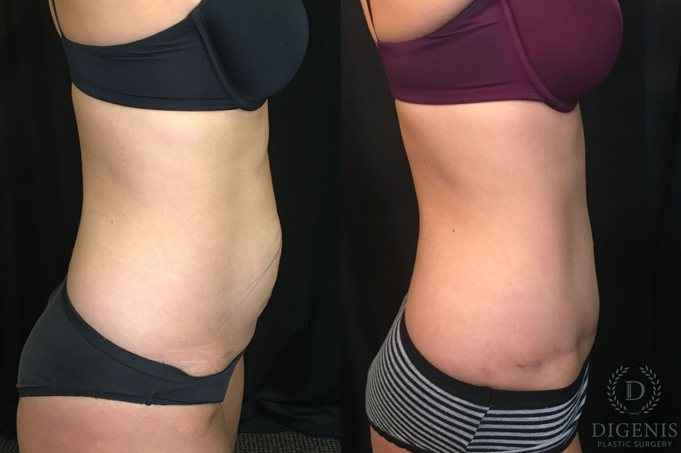 Before and after Tummy Tuck case 35152 - Angle 3
