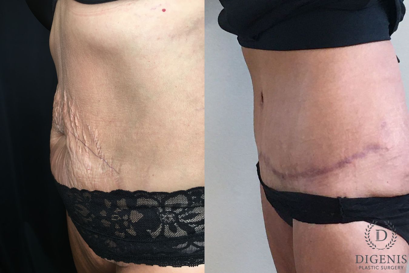 Before and after Tummy Tuck case 35185 - Angle 4