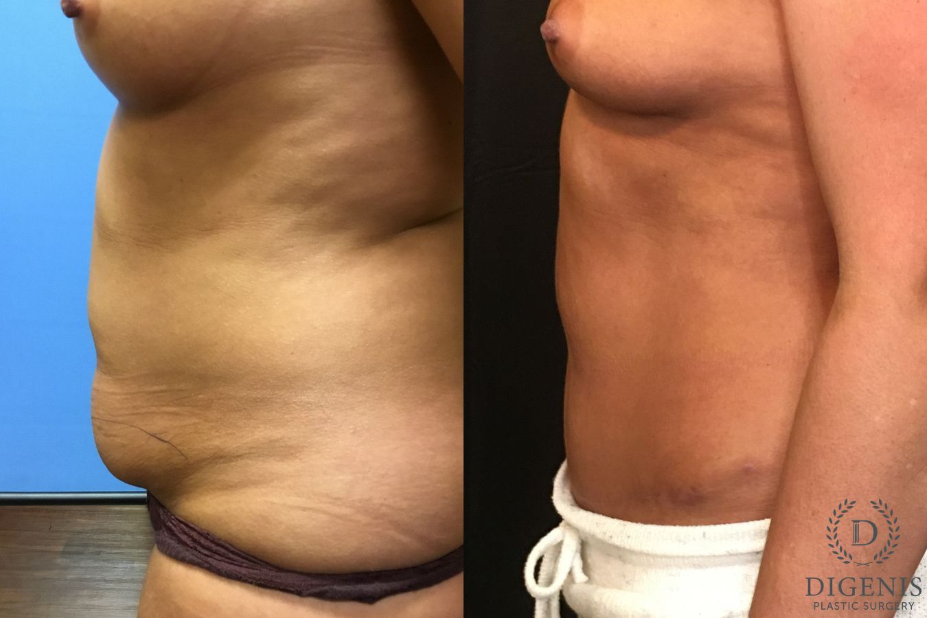 Before and after Tummy Tuck case 35066 - Angle 5
