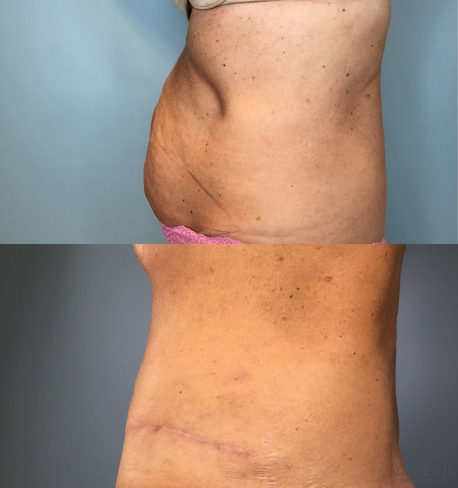 Before and after Tummy Tuck case 49484 - Angle 3