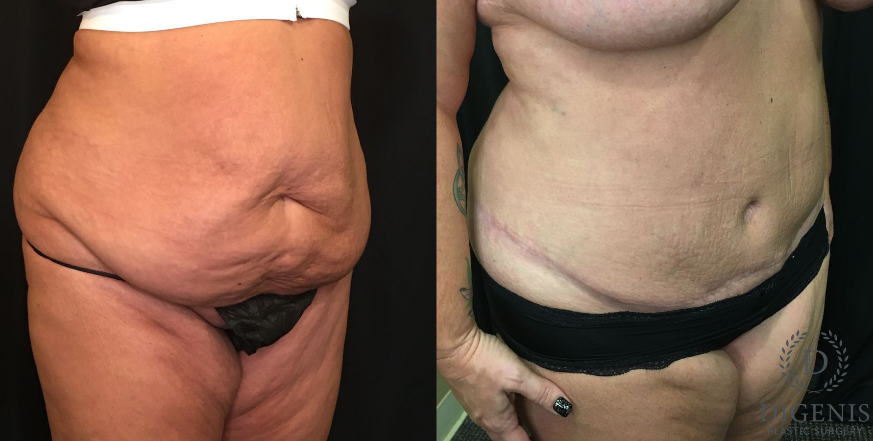 Before and after Tummy Tuck case 35143 - Angle 2