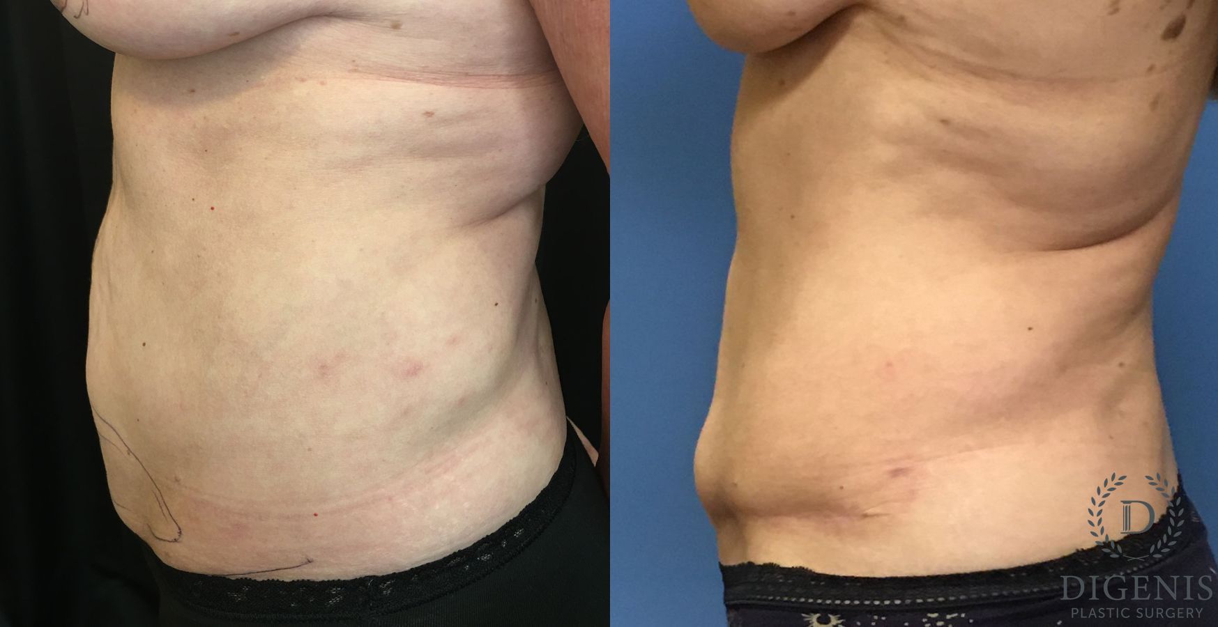 Before and after Tummy Tuck case 35184 - Angle 5