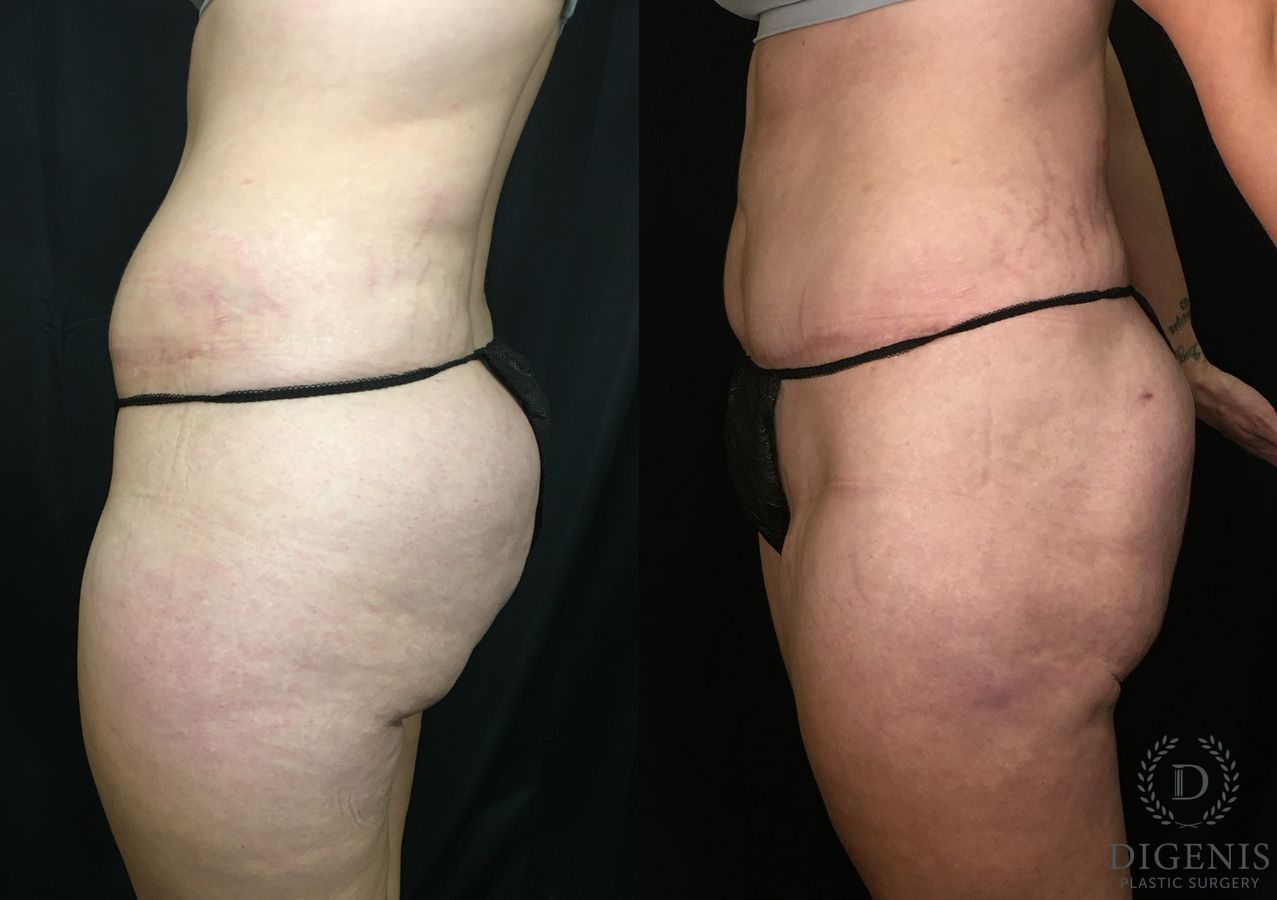 Before and after Tummy Tuck case 35180 - Angle 5