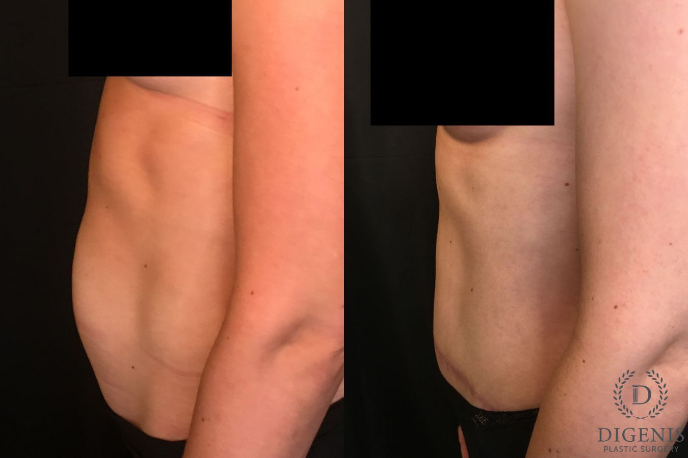 Before and after Tummy Tuck case 35052 - Angle 5