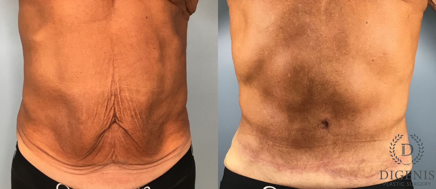 Before and after Tummy Tuck case 43448